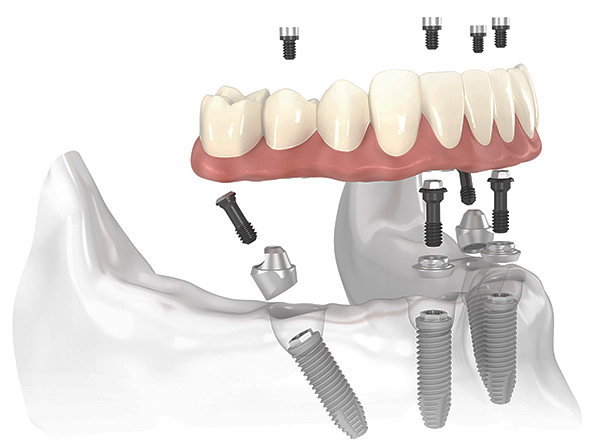 El esquema de implementación de prótesis dental All-on-4.