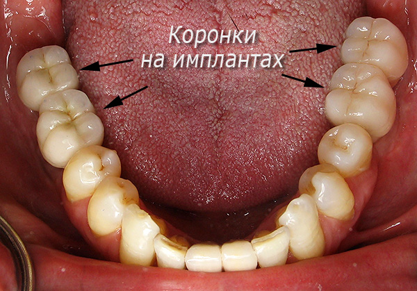 Prótesis de masticar dientes sobre implantes Alpha BIO