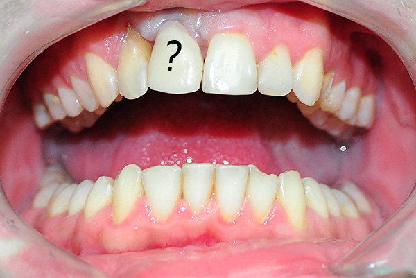 Con una higiene bucal inadecuada, la inflamación puede comenzar en el área del implante.