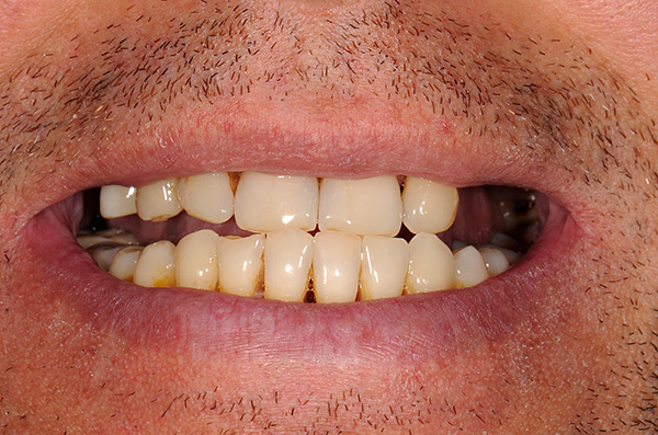 La foto muestra el estado de los dientes del paciente antes del tratamiento con prótesis en implantes.