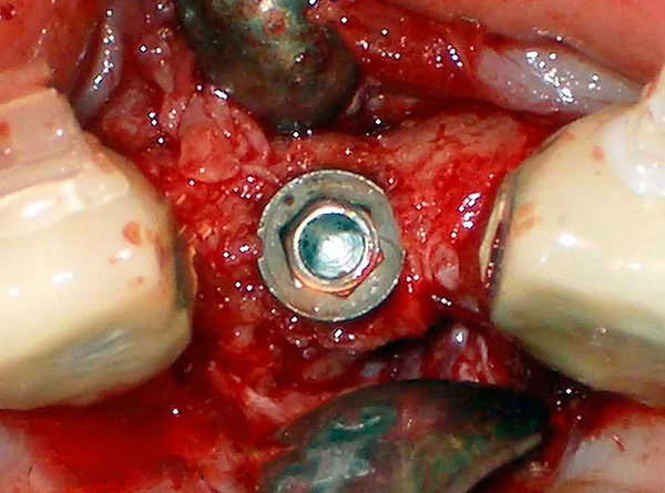 Implante Alpha BIO en la mandíbula: un pozo en forma de hexágono es claramente visible (debajo del pilar).