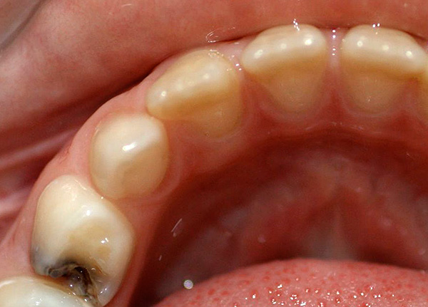 En caso de dolor agudo en el diente, es recomendable buscar inmediatamente atención dental de emergencia.