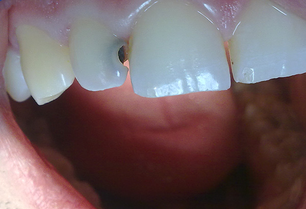 Το κύριο πράγμα - μην χρησιμοποιείτε παυσίπονα ως εναλλακτική λύση για την επίσκεψη στον οδοντίατρο.
