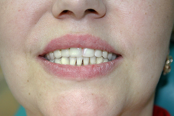 A alguien no le gustan las dentaduras acrílicas, mientras que algunos pacientes hablan muy positivamente sobre ellas.