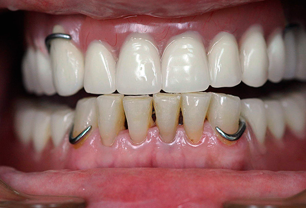 धातु हुक - यह एक एक्रिलिक दांत की पकड़ है।