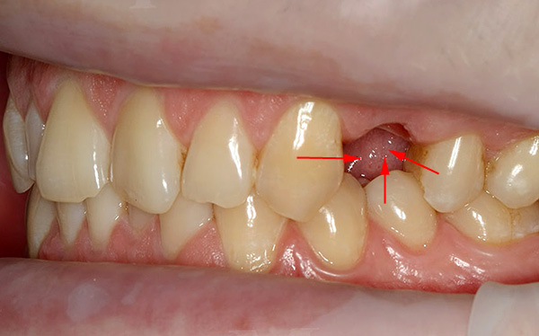 Las flechas de la foto muestran la dirección del desplazamiento de los dientes cuando aparece un espacio vacío en su fila.