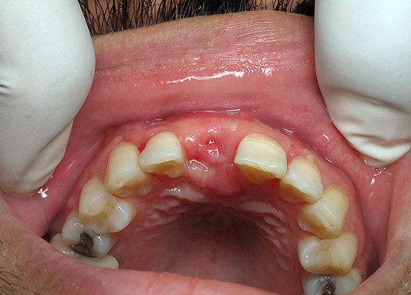 Es muy indeseable ir sin prótesis de los dientes extraídos durante mucho tiempo.