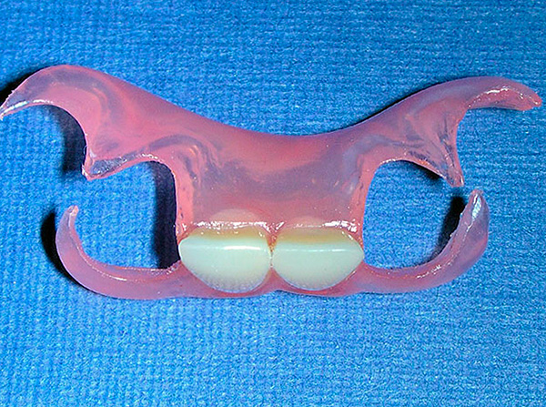 La foto muestra una prótesis de mariposa para prótesis de dos dientes frontales.
