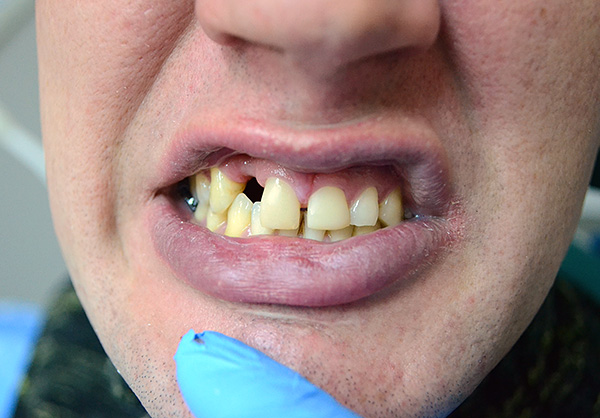 Así era como se veían los dientes del paciente antes de usar una prótesis de mariposa ...