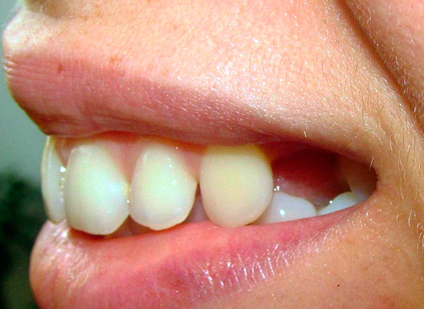 Foto antes de la extracción protésica de los dientes.