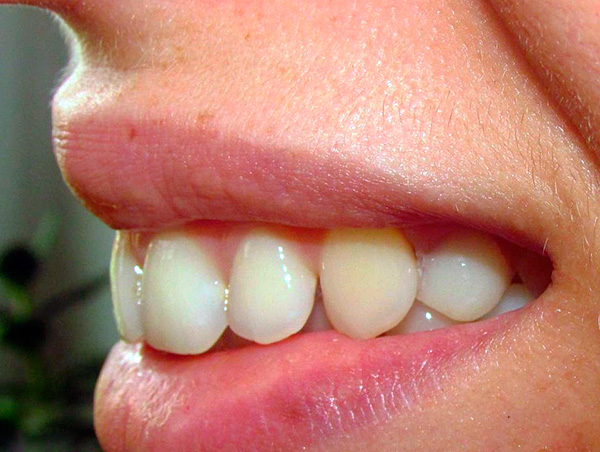 Y esta foto muestra el estado de los dientes después de usar una prótesis de mariposa.