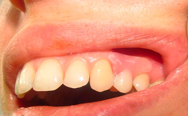 El diente restaurado por la prótesis es prácticamente indistinguible de los dientes nativos del paciente.