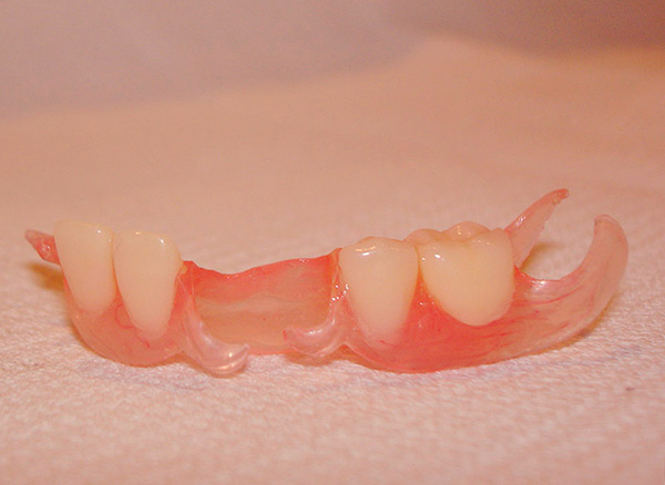 Con una gran cantidad de dientes protésicos, la prótesis inmediata a la mariposa ya no es muy similar ...