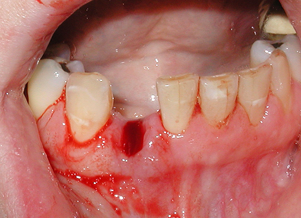 Al usar una prótesis inmediata, no es necesario caminar durante varias semanas con un orificio en la dentición.