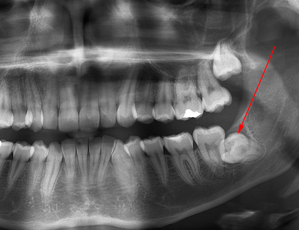 Hablemos sobre los dientes impactados (en primer lugar, la sabiduría) y algunos de los matices asociados con su extracción ...