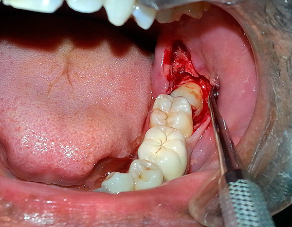 La foto muestra la extracción del octavo diente inferior ubicado horizontalmente en la mandíbula.