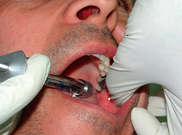 En la mayoría de los casos, la anestesia local permite incluso la extracción difícil del diente impactado con poco o ningún dolor.