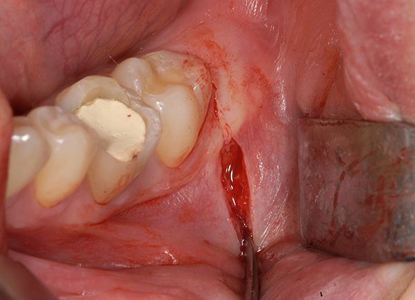 Para extraer la muela del juicio impactada de la mandíbula, primero se hace una incisión en la encía.