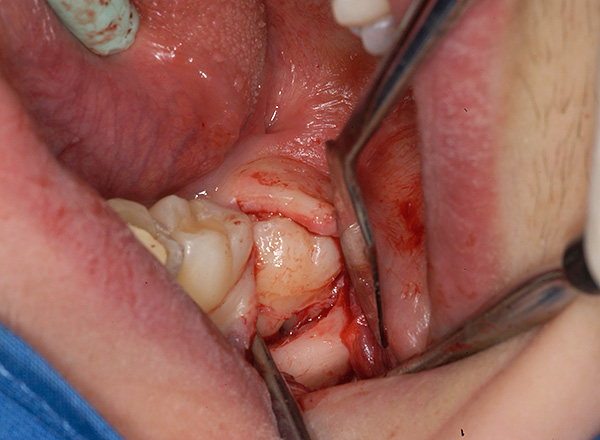 La parte coronal del diente impactado es visible en la luz de la incisión.