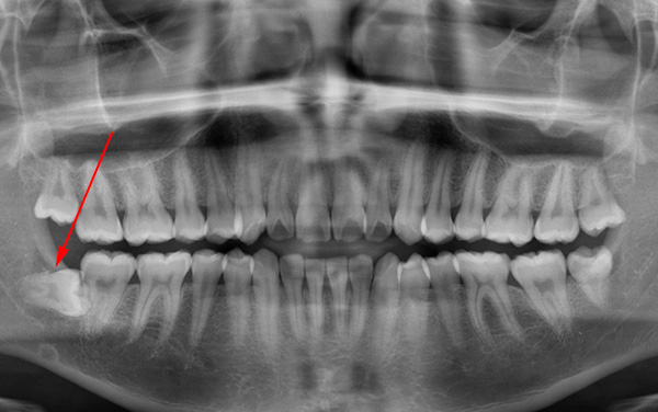 Con una disposición horizontal de la muela del juicio en la mandíbula, se apoya en el siete, como resultado de lo cual no puede estallar.