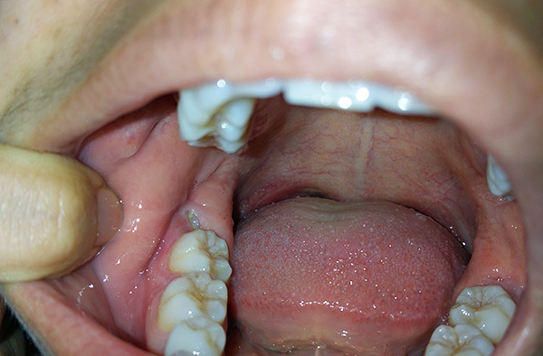 A menudo, los ochos se cortan completamente sin dolor, tomando su lugar al final de la dentición.