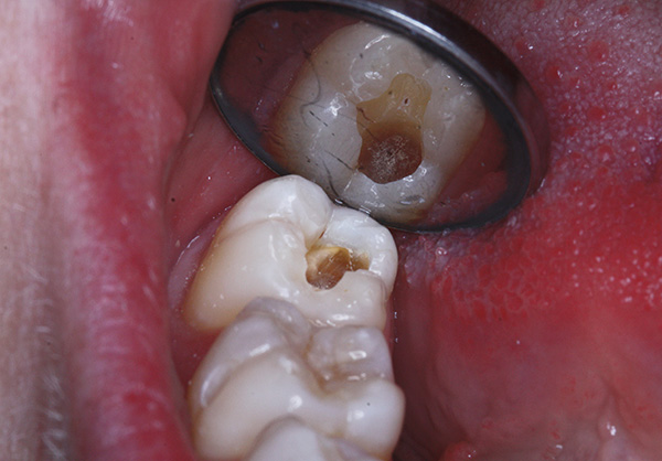 A veces a los pacientes les parece que el médico perfora un diente demasiado fuerte, como si estuviera sintiendo placer por este proceso ...