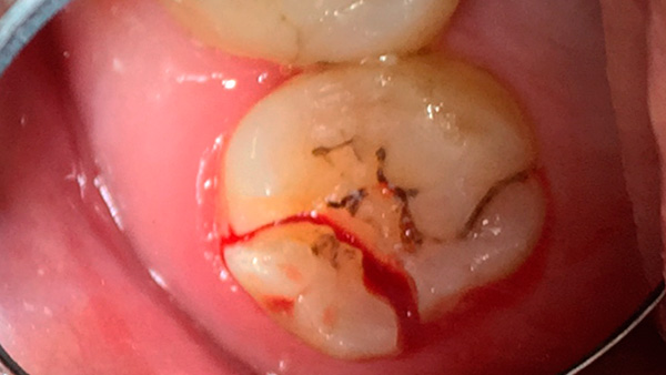 Si el diente (cualquiera) se rompe para que la grieta penetre profundamente debajo de la encía, entonces, en general, las posibilidades de las prótesis en este caso están muy limitadas.