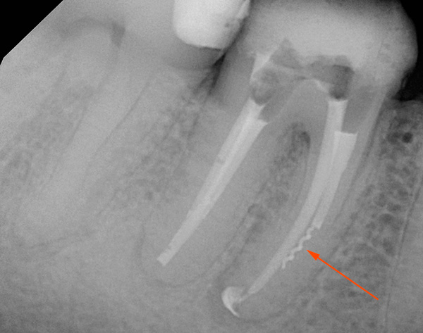 La imagen muestra claramente el fragmento restante del instrumento dental en el canal; si no se extrae, en el futuro puede causar inflamación en el vértice de la raíz del diente.