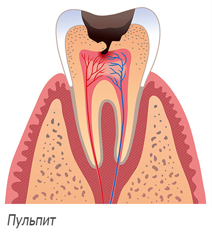 La imagen muestra esquemáticamente la pulpitis del diente.