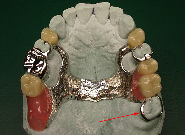 Las muelas del juicio se pueden utilizar como soporte para dentaduras postizas.