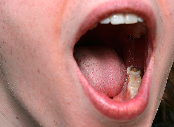 Incluso con una destrucción tan significativa del diente, a veces es posible salvar de la extracción.