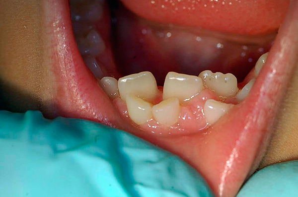 Si ya se han hecho erupciones en los dientes permanentes, mientras que los lácteos no se caen por sí mismos, entonces tendrán que ser removidos con una alta probabilidad.