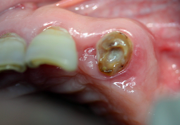 A menudo, los dientes muy dañados son realmente imposibles de agarrar con un fórceps, ya que no hay nada que agarrar.