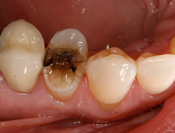 A menudo sucede que cuando intentas agarrar un diente con un fórceps, su corona rota se desmorona y se rompe con un crujido.