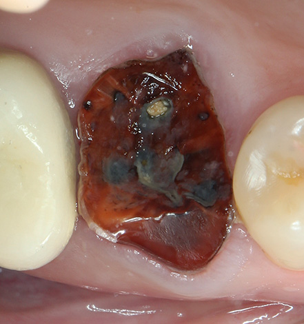 A veces, esas raíces de dientes podridos tienen que ser literalmente cortadas en pedazos, lo que contribuye al costo final del procedimiento.