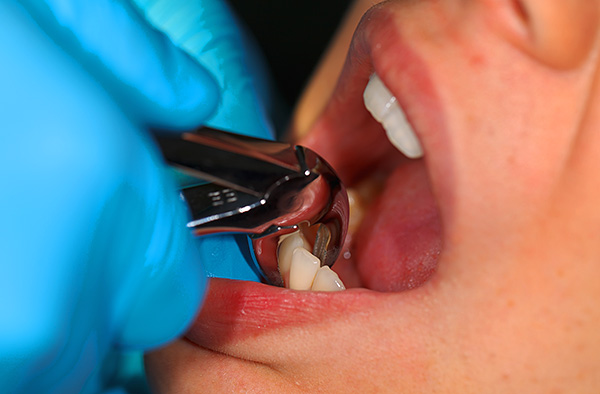 La eliminación de los incisivos, por regla general, es fácil, pero si durante un procedimiento se rompe un diente, es muy difícil extraer la raíz.