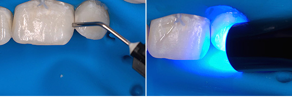En el último paso del procedimiento, el polímero se cura con la luz de una lámpara ultravioleta.