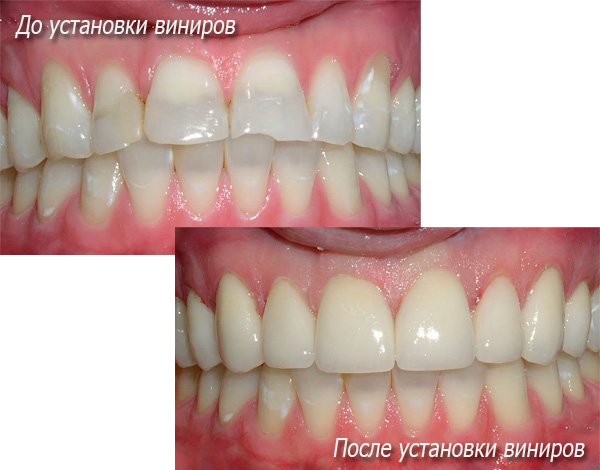 La foto muestra el estado de los dientes del paciente antes y después de instalar las carillas ...