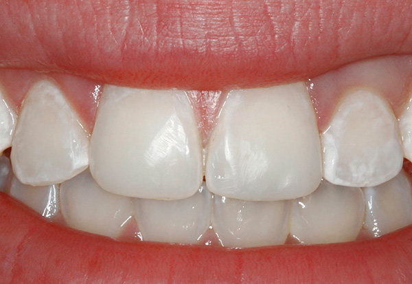 Por lo general, la caries en la etapa de la mancha blanca (cretácea) se ve mejor en el grupo frontal de los dientes.