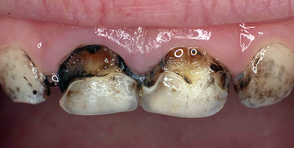 A menudo, los dientes plateados no tienen un impacto significativo en el desarrollo posterior del proceso de caries.