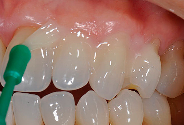 El tratamiento de los dientes con preparaciones especiales permite detener el desarrollo de caries iniciales y, en algunos casos, incluso eliminar por completo las manchas blancas en el esmalte.