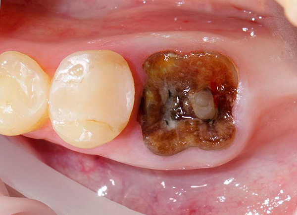 Vamos a hablar sobre el procedimiento para la eliminación de las raíces de los dientes y algunas de las dificultades que acompañan tales manipulaciones ...