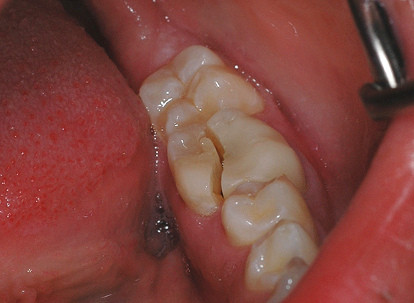 Otro ejemplo de una fractura de diente muy desafortunada, cuando lo más probable es que tenga que desprenderse de ella.