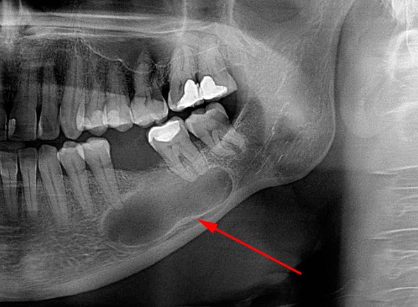 La foto muestra un ejemplo de un quiste enorme, que ya estimula las raíces de dos dientes a la vez.