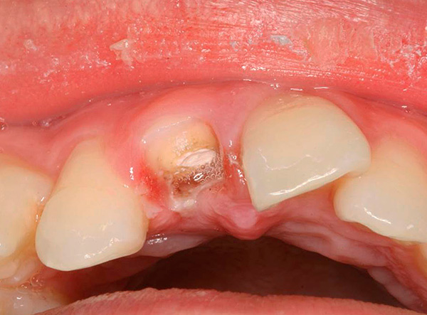 La raíz de un diente tan fuertemente destruido debe ser eliminada.