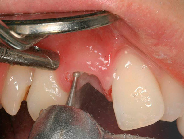 La raíz de un diente se corta con un taladro en pedazos ...