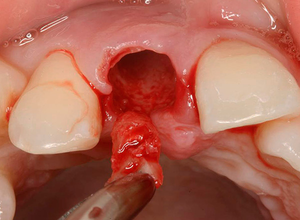 Como resultado, toda la raíz del diente se extrae del orificio.