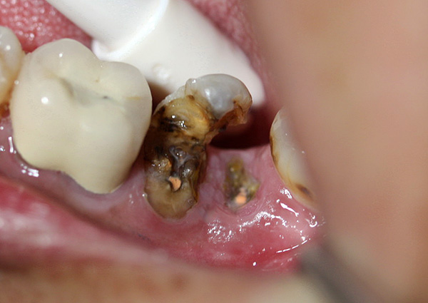 En pacientes de edad avanzada, la eliminación de las raíces de los dientes podridos, por regla general, no presenta grandes dificultades.
