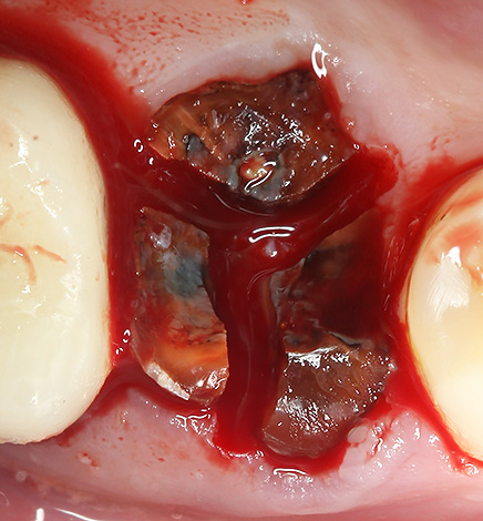 Οι ρίζες του δοντιού χωρίζονται με ένα τρυπάνι για να απλοποιηθεί η διαδικασία για την απομάκρυνσή τους από την τρύπα.