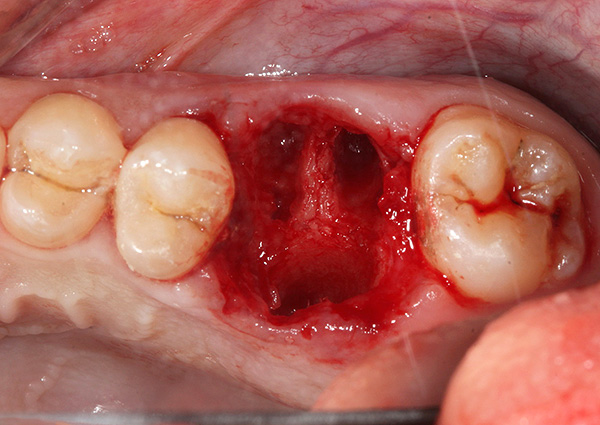 Μερικές φορές όταν απομακρύνεται ένα δόντι σε μια τρύπα, μπορεί να παραμένει μια σπασμένη κορυφή της ρίζας ή μόνο τα μικρά κομμάτια ...